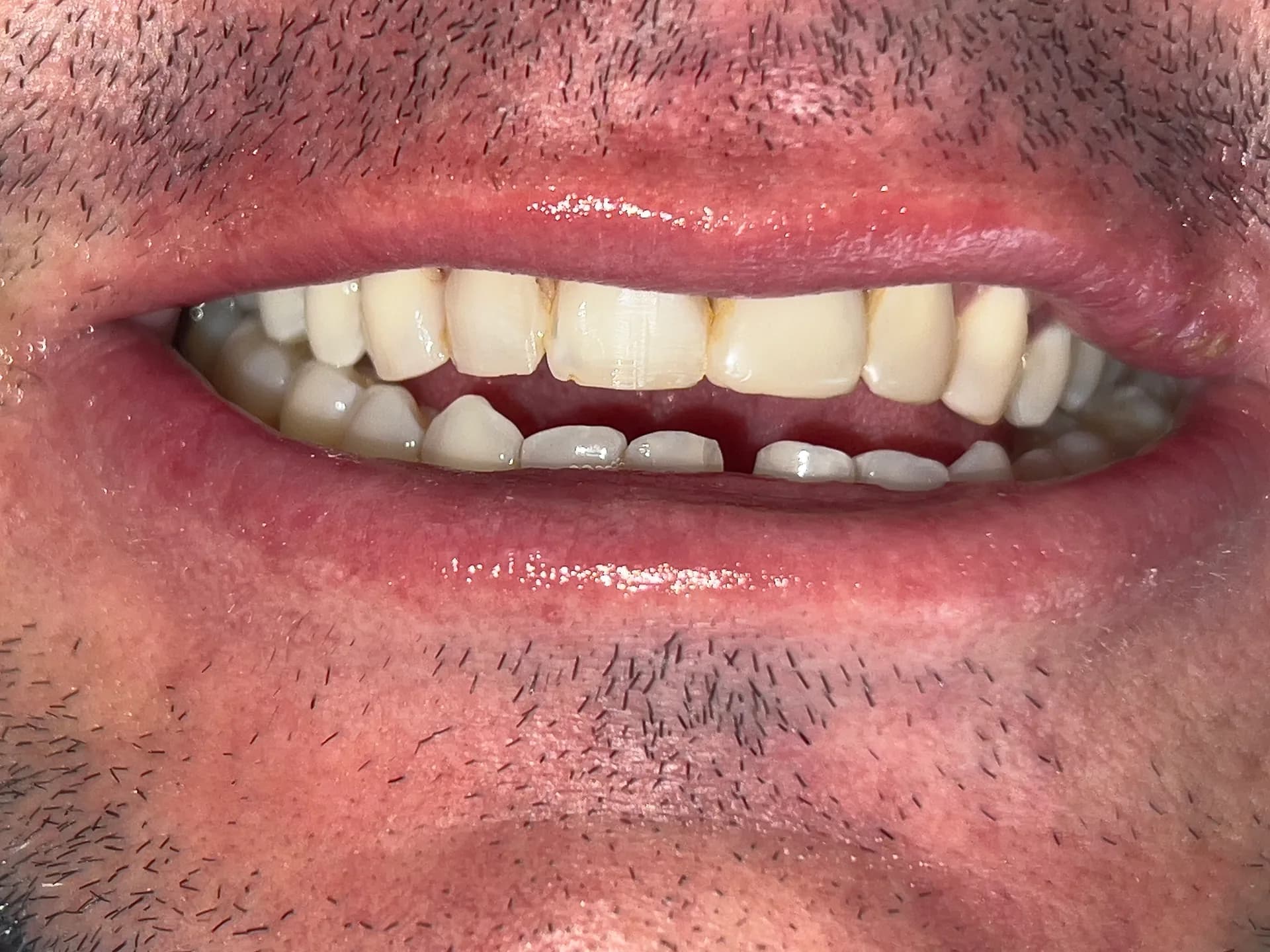 Antes: Antes y después de rediseño de sonrisa en Medellín, Dra. Carolina Macareno