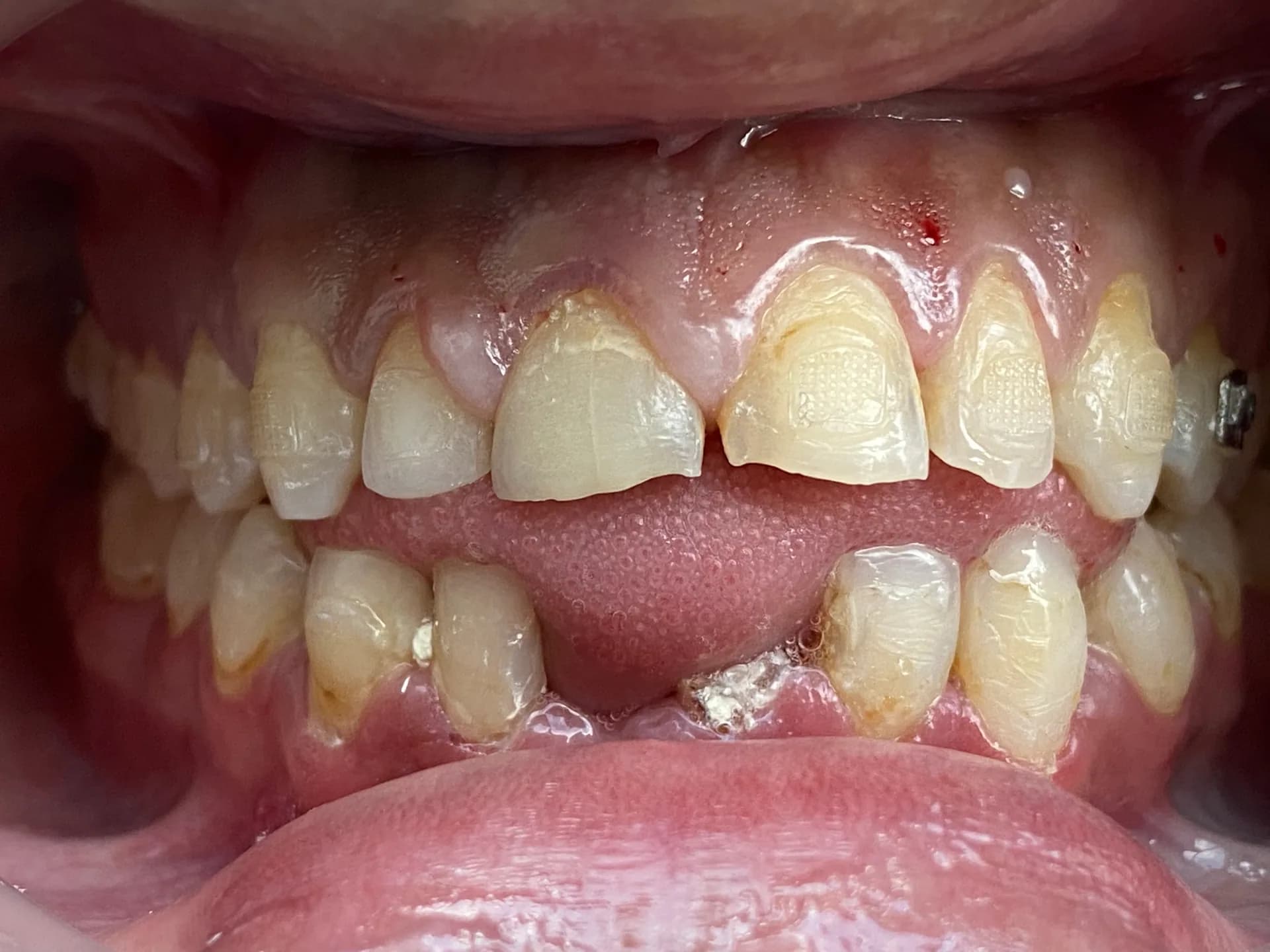 Antes: Antes y después de diseño de sonrisa con carillas cerámicas en Medellín, Dra. Carolina Macareno