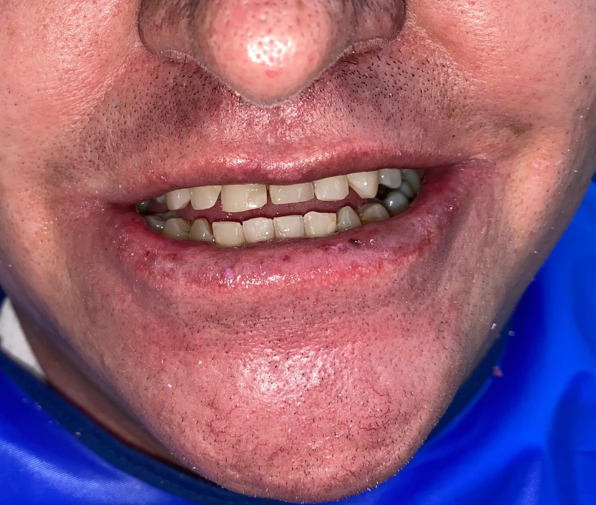 Antes: Caso de diseño de sonrisa cerámico antes y después, Medellín