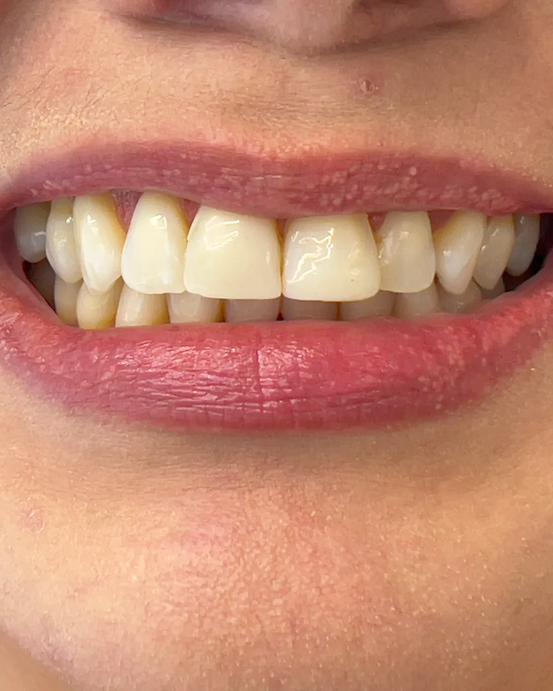 Antes: Antes y después de diseño de sonrisa cerámico en Medellín, Dra. Carolina Macareno