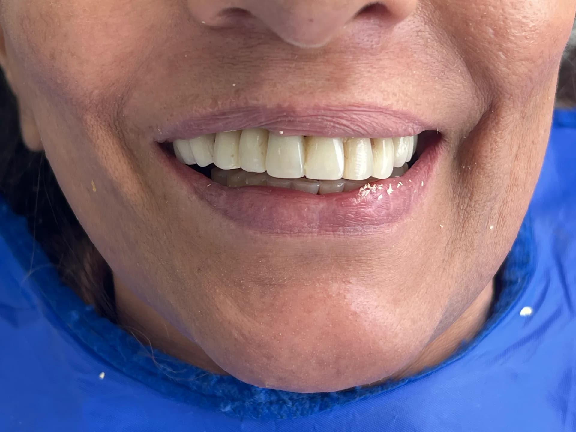 Antes: Antes y después de rehabilitación oral en Medellín, Dra. Carolina Macareno