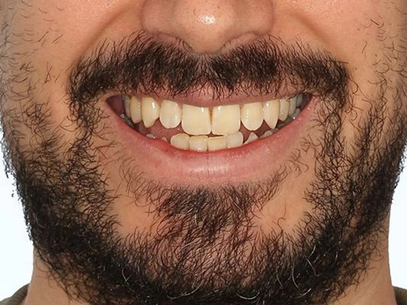 Antes y después de un tratamiento con alineadores y microdiseño en resina directa, sin tallar los dientes (antes)