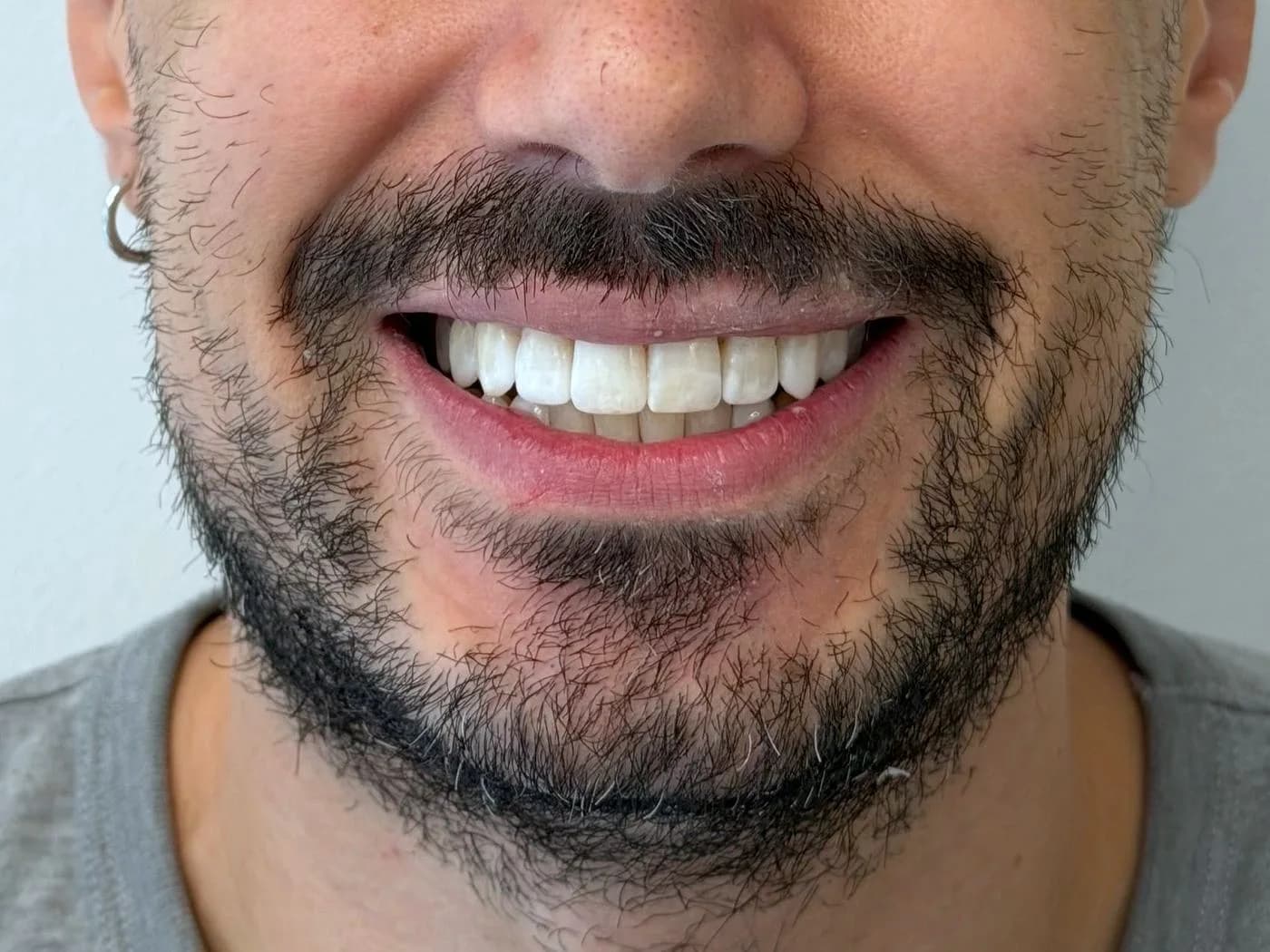 Antes y después de un tratamiento con alineadores y microdiseño en resina directa, sin tallar los dientes (después)