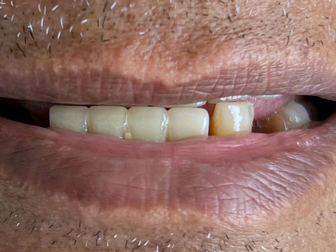 Antes y después de una rehabilitación con cuatro implantes cigomáticos y prótesis fija bimaxilar en zirconio en Medellín (antes)