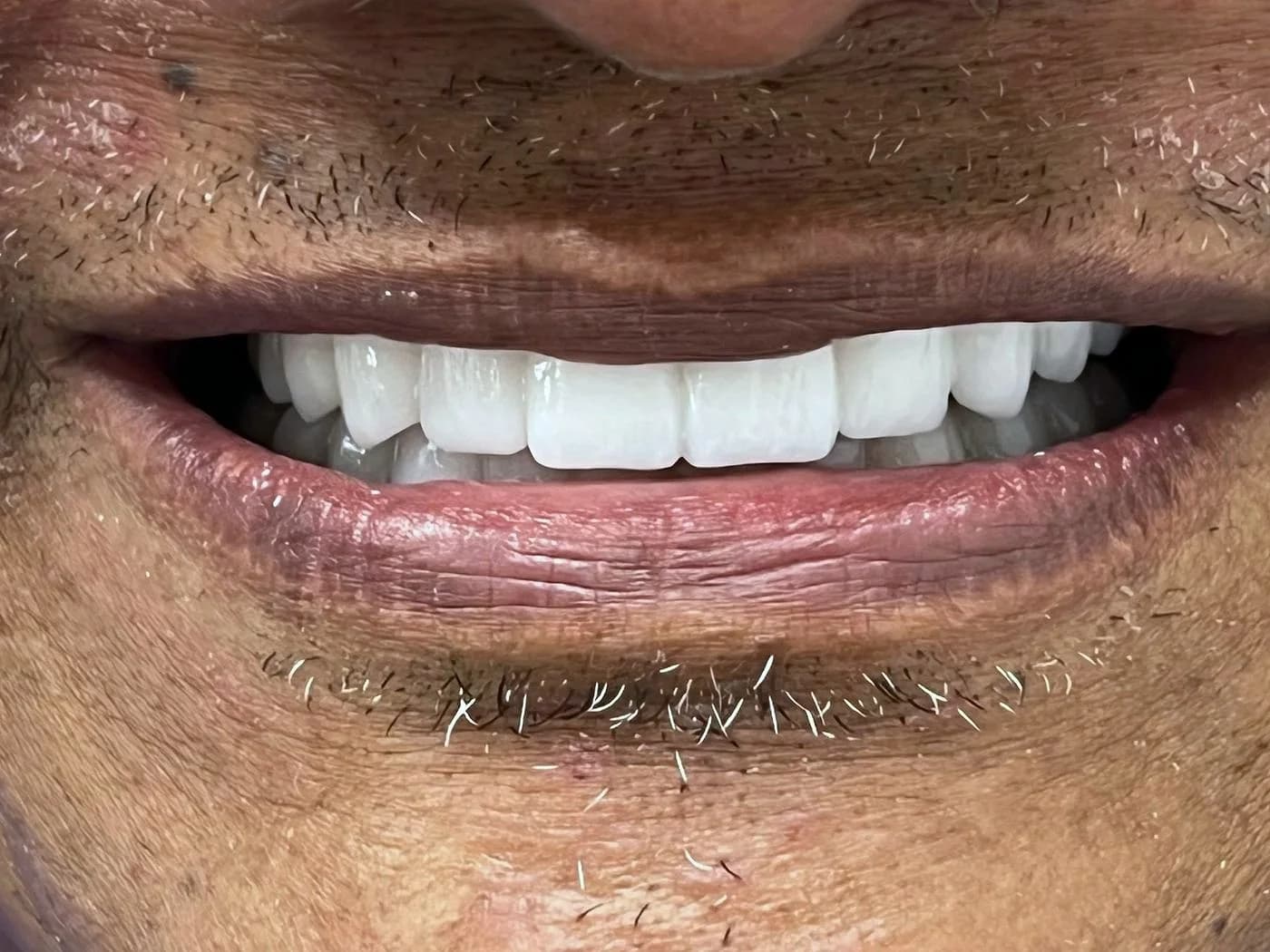 Antes y después de una rehabilitación con cuatro implantes cigomáticos y prótesis fija bimaxilar en zirconio en Medellín (después)