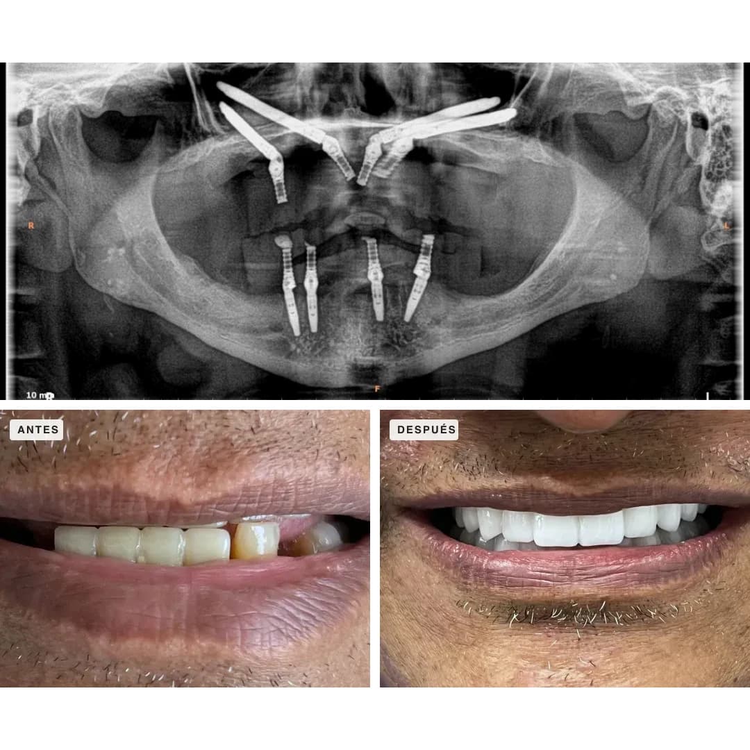 Caso real de implantes cigomáticos: radiografía con cuatro cigomáticos en el maxilar superior y cuatro convencionales en el inferior, y la sonrisa antes y después, Dra. Carolina Macareno, Medellín