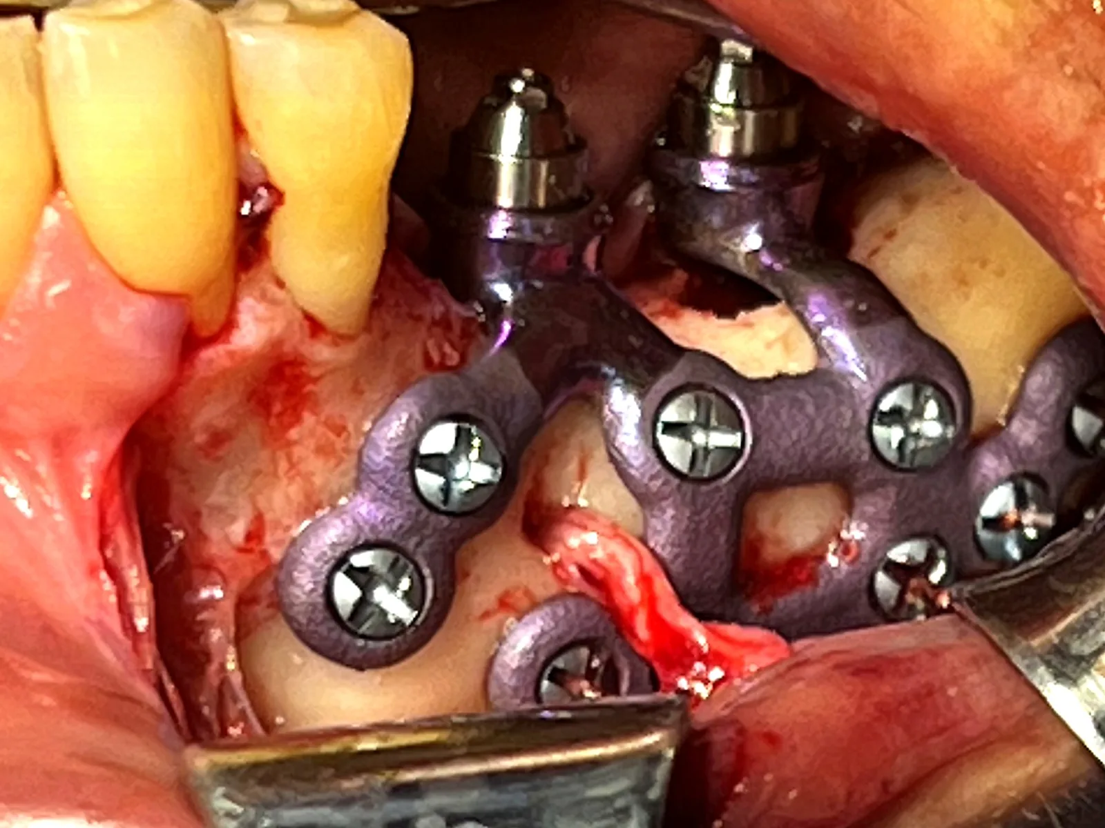 2. Colocación Quirúrgica