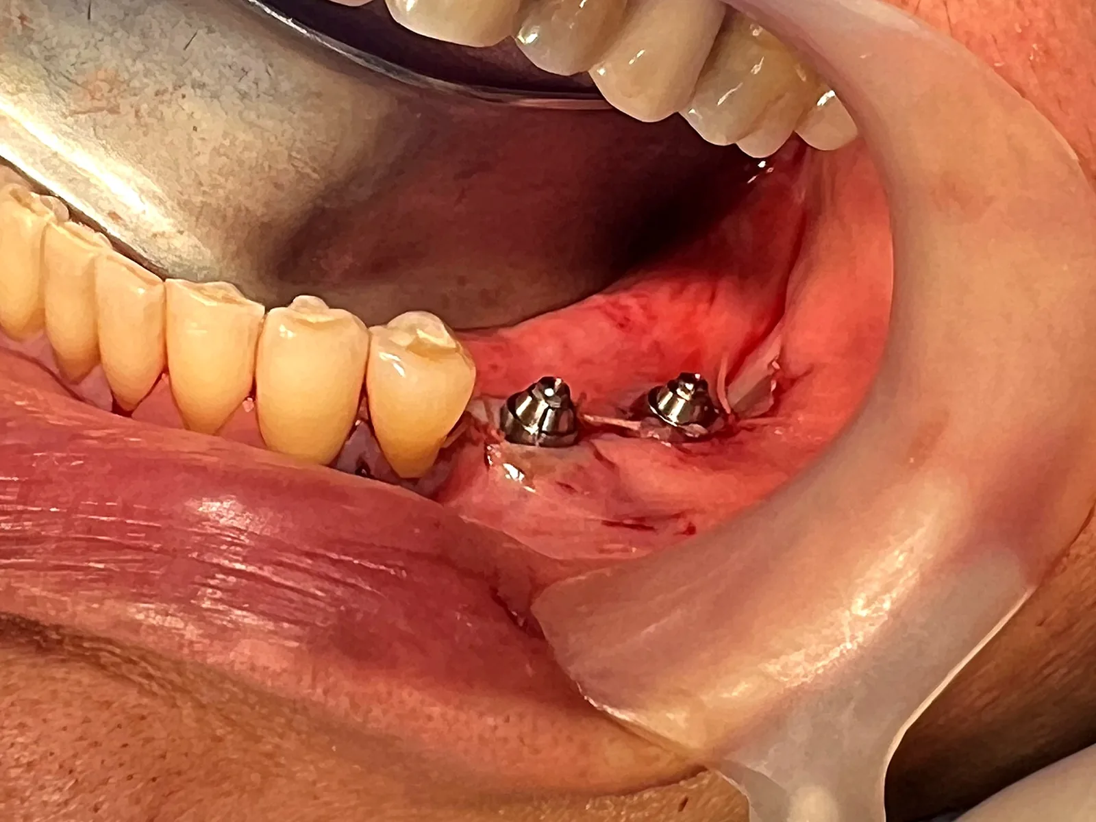 Implante Subperióstico