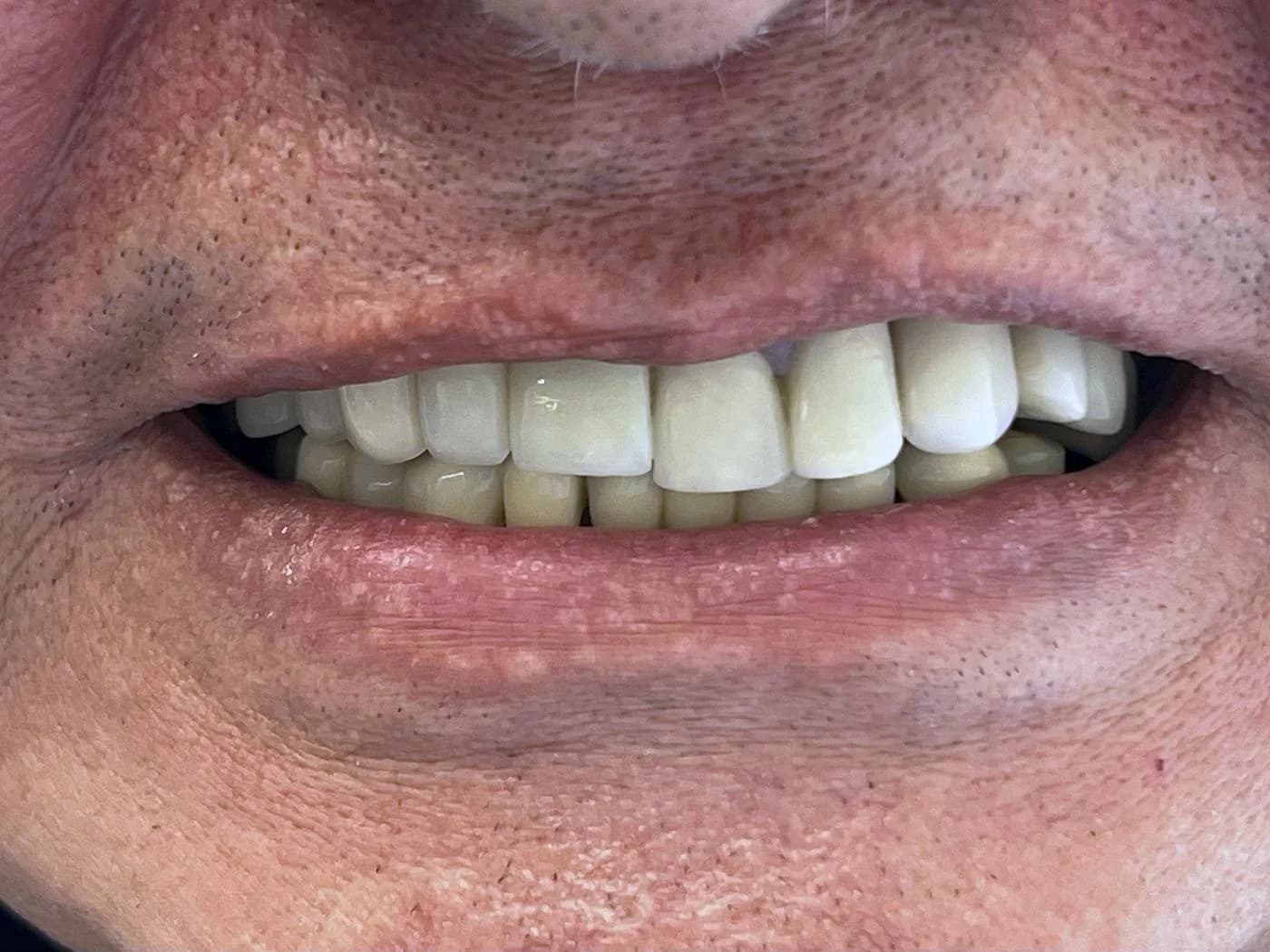 Antes y después de una prótesis fija en coronas de zirconio en Medellín, caso rehecho tras un tratamiento previo (antes)
