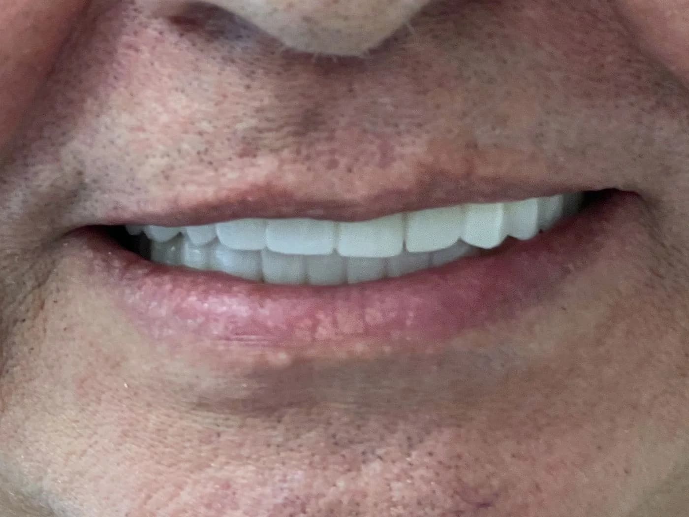 Antes y después de una prótesis fija en coronas de zirconio en Medellín, caso rehecho tras un tratamiento previo (después)