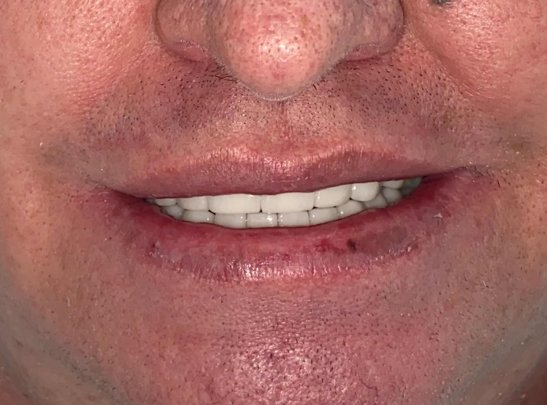 Después: Caso de diseño de sonrisa cerámico antes y después, Medellín