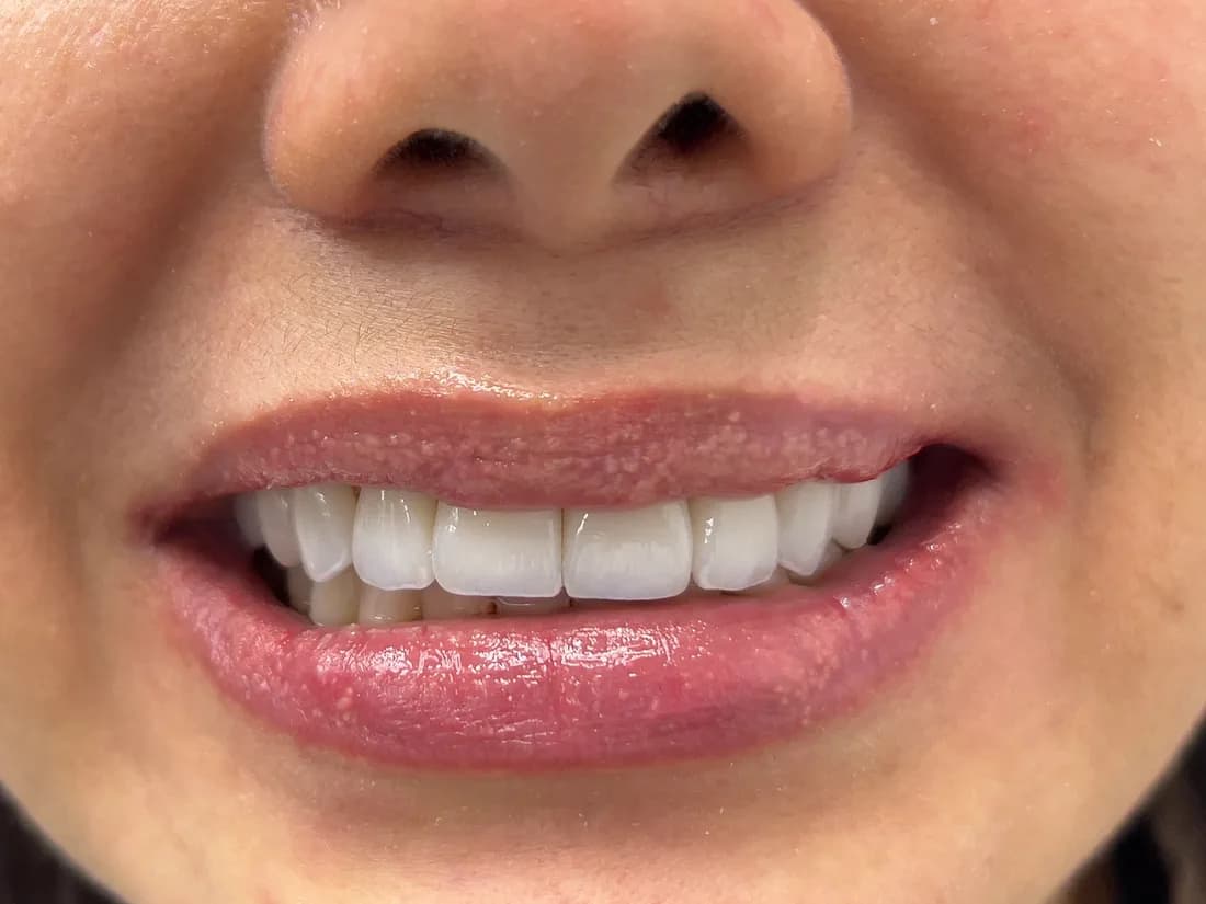 Resultado final de diseño de sonrisa con carillas cerámicas en Medellín, Dra. Carolina Macareno