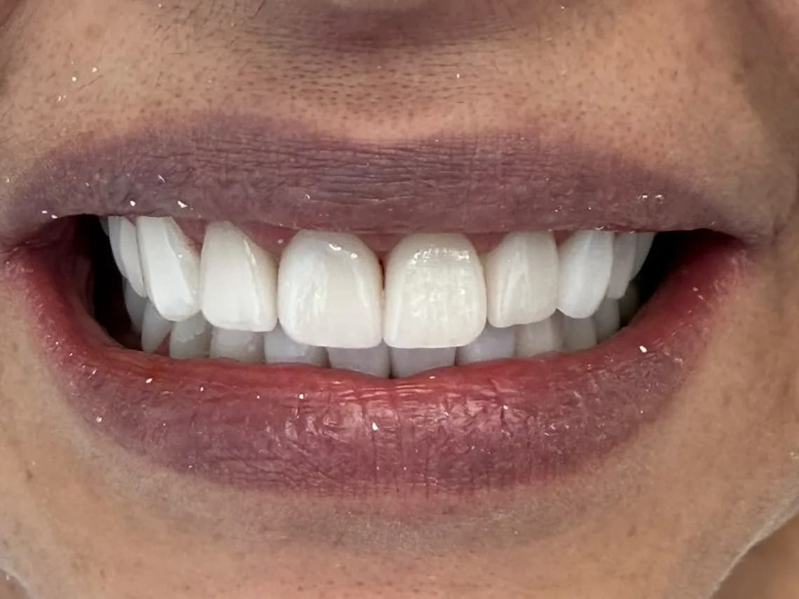 Después del diseño de sonrisa