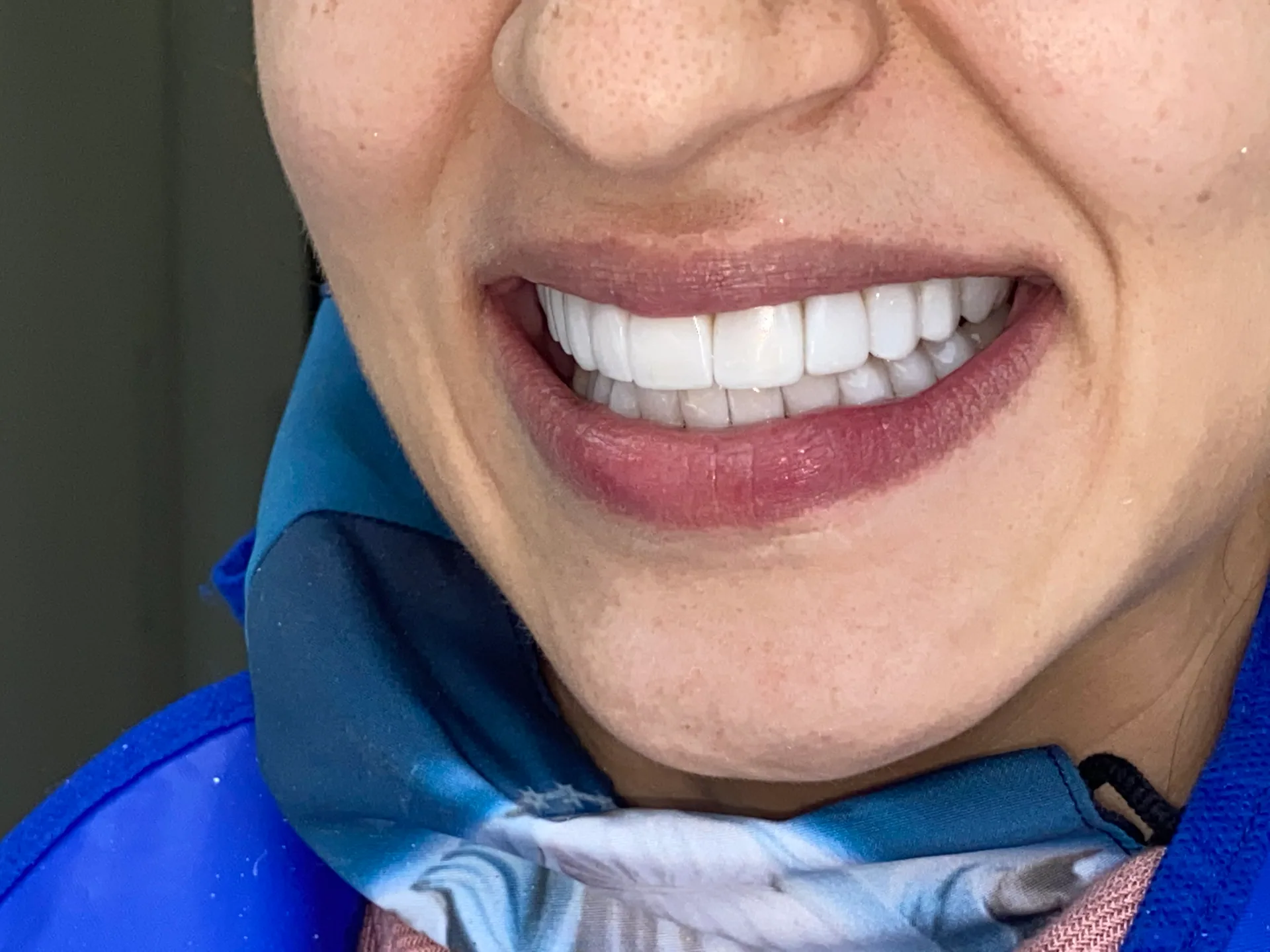 Después: Antes y después de carillas en resina, diseño de sonrisa Medellín