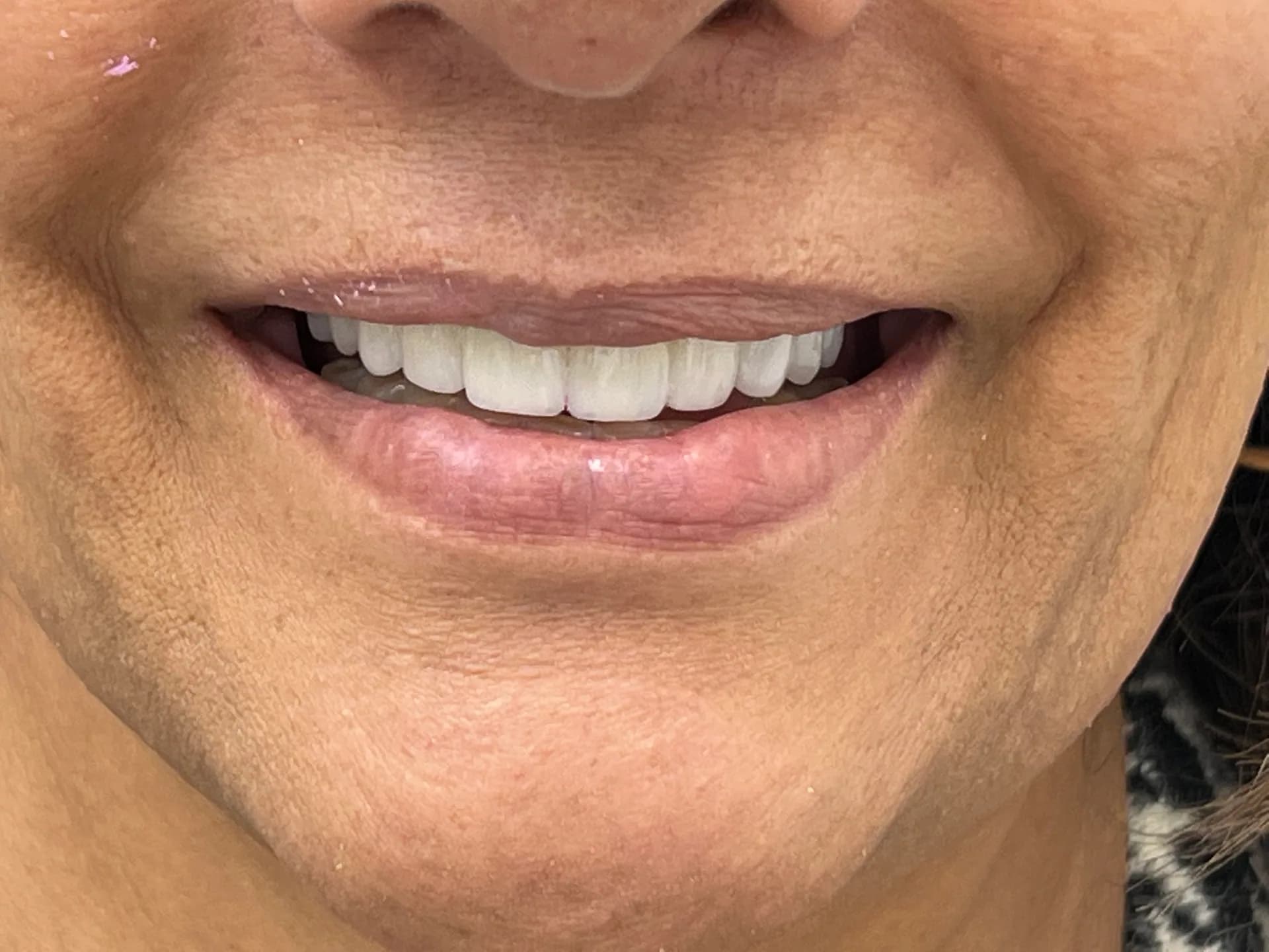 Después: Antes y después de rehabilitación oral en Medellín, Dra. Carolina Macareno
