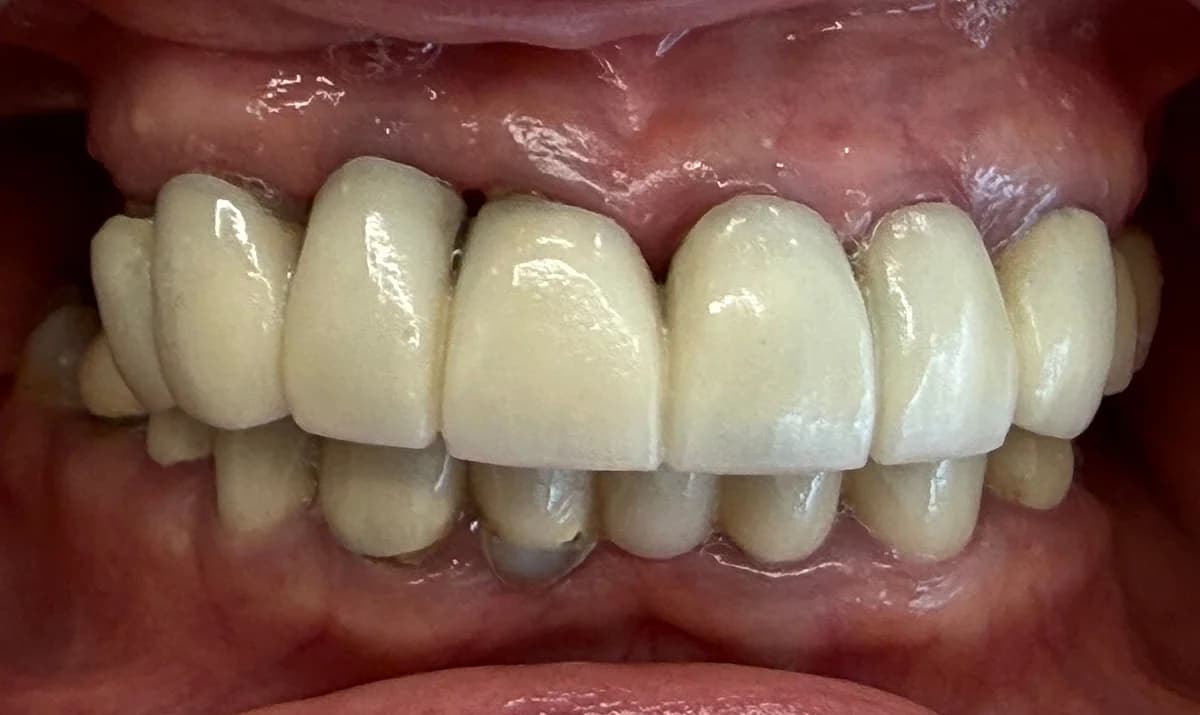 Estado inicial de un caso de All-on-6 y All-on-4, con enfermedad periodontal avanzada