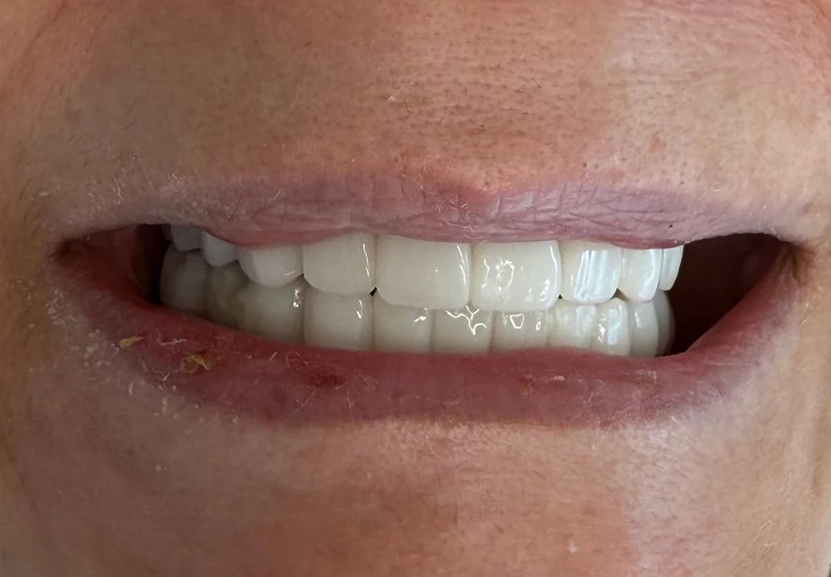 Prótesis provisional fija colocada el mismo día de la cirugía de implantes