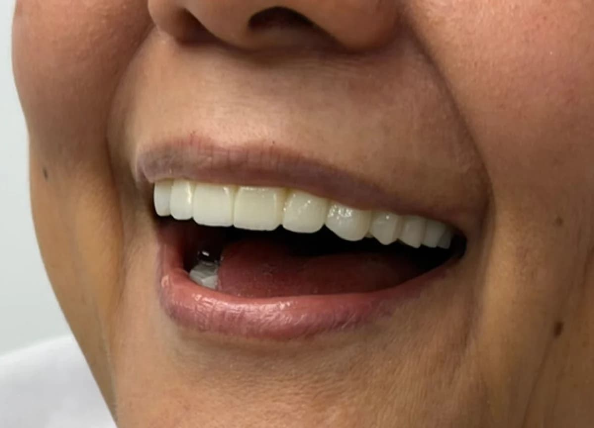 Resultado final con prótesis fija híbrida en zirconio sobre implantes