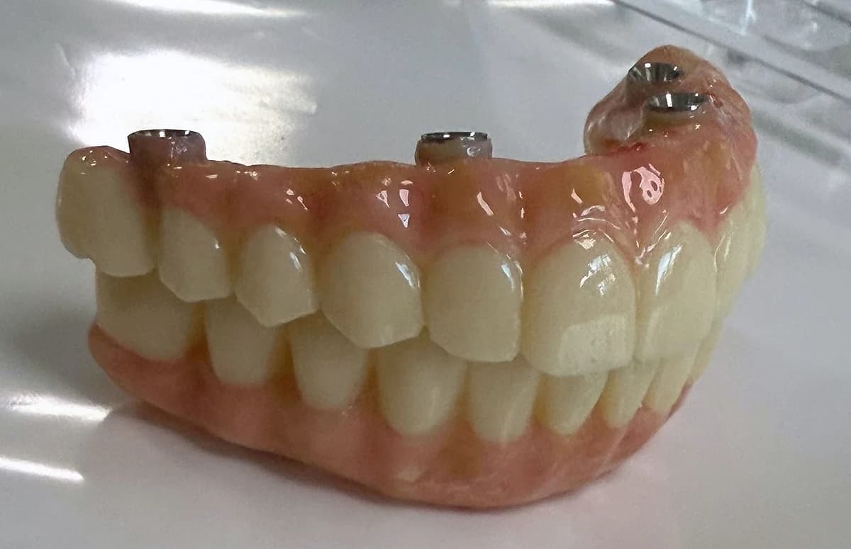 Prótesis híbrida completa sobre implantes, arcada superior e inferior montadas, antes de instalarla