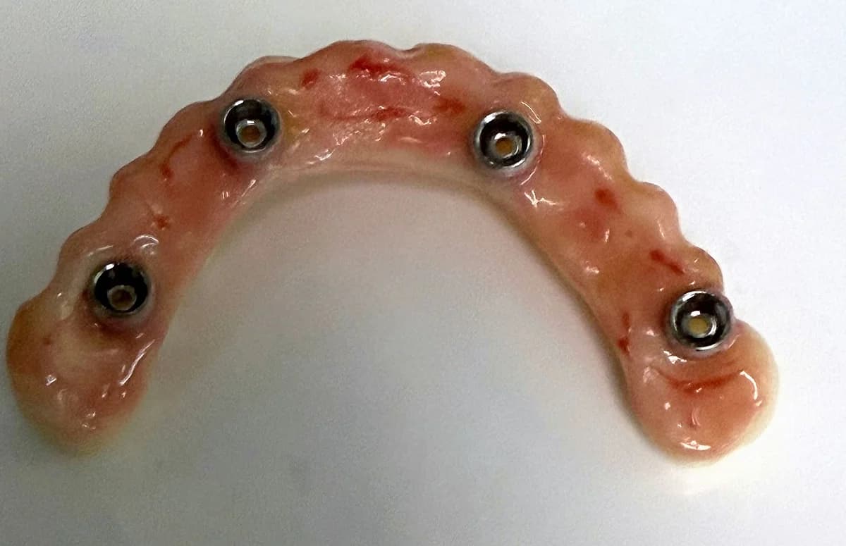 Reverso de una prótesis híbrida atornillada donde se ven los cuatro alojamientos de los tornillos