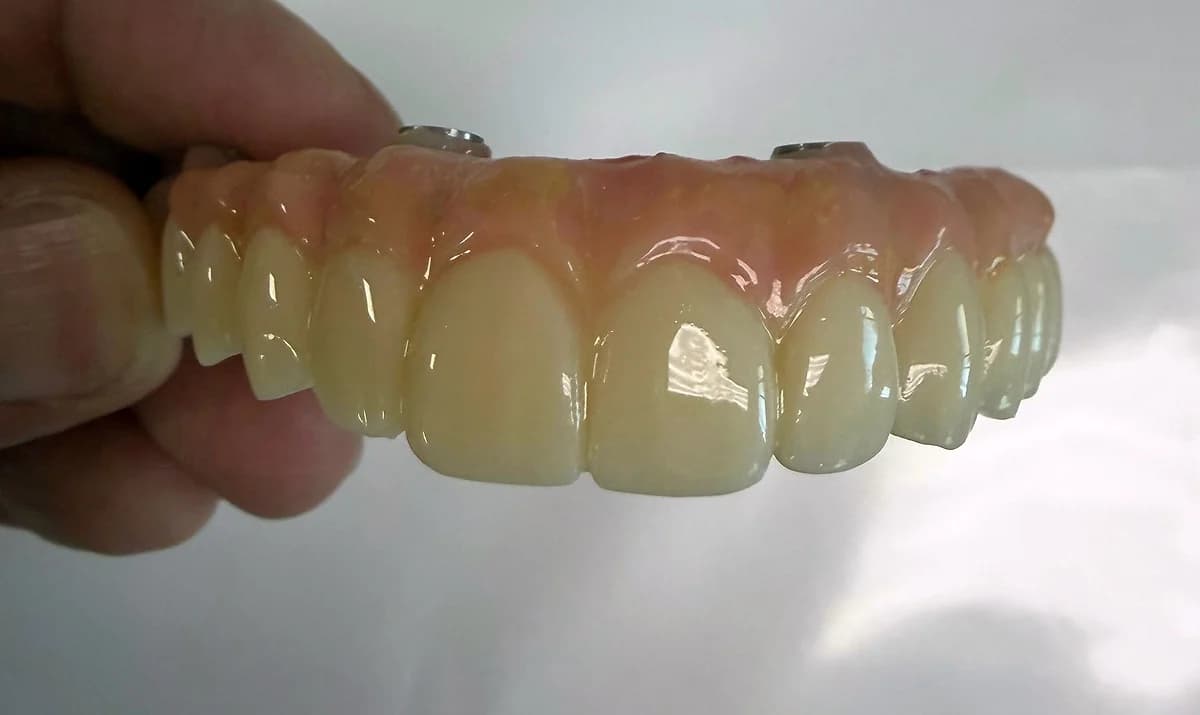 Detalle frontal de los dientes de una prótesis híbrida sostenida en la mano