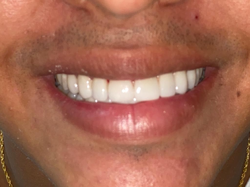Caso clínico de diseño de sonrisa cerámico — Dra. Carolina Macareno Medellín