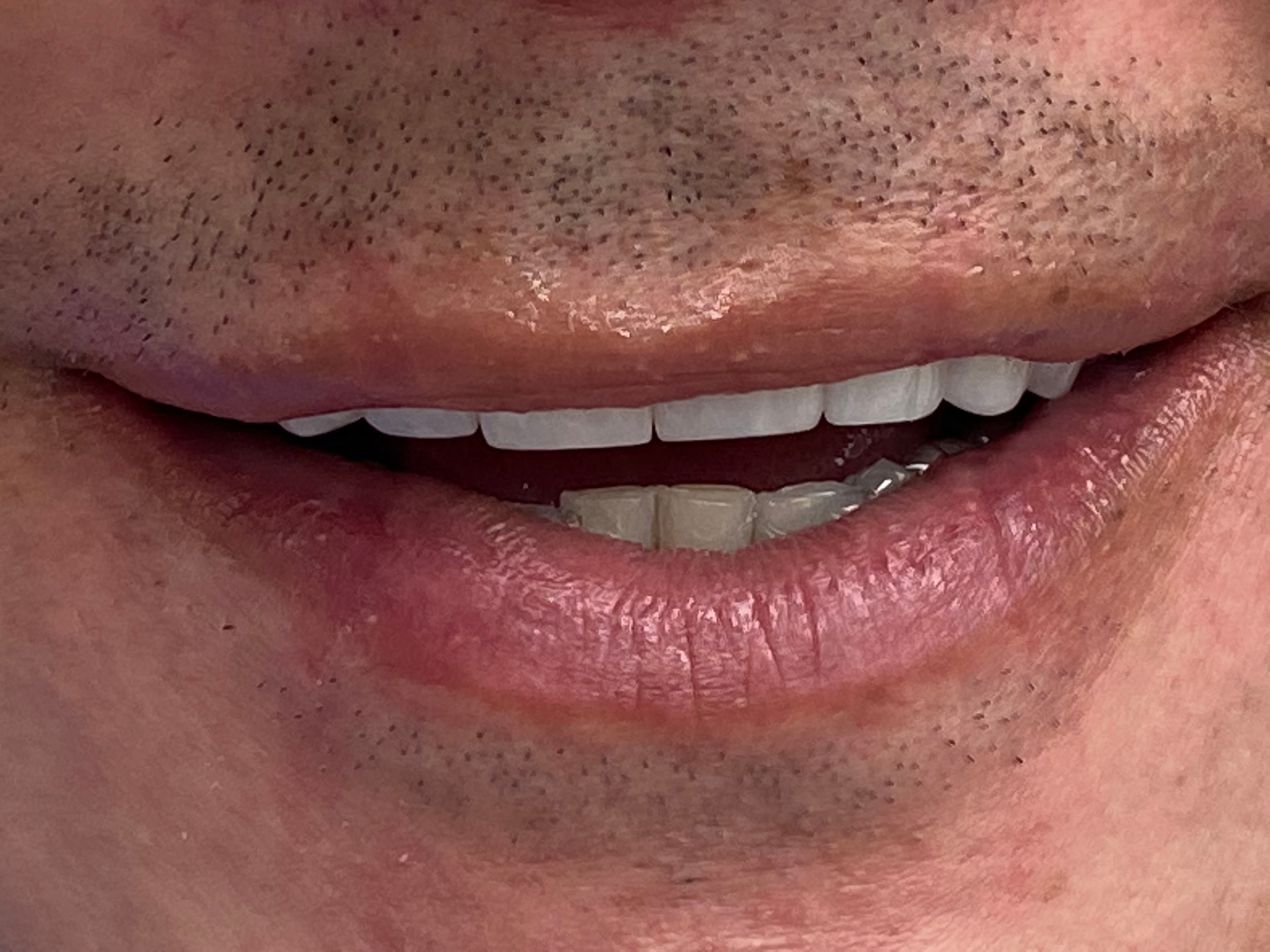 Diseño de sonrisa cerámico con carillas en Medellín