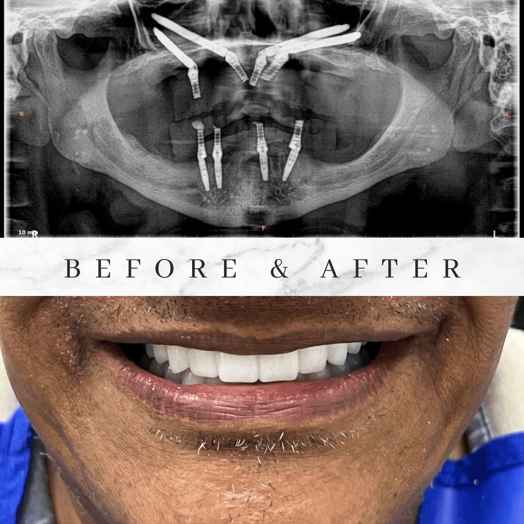 Implantes dentales en Medellín — implantes cigomáticos y subperiósticos