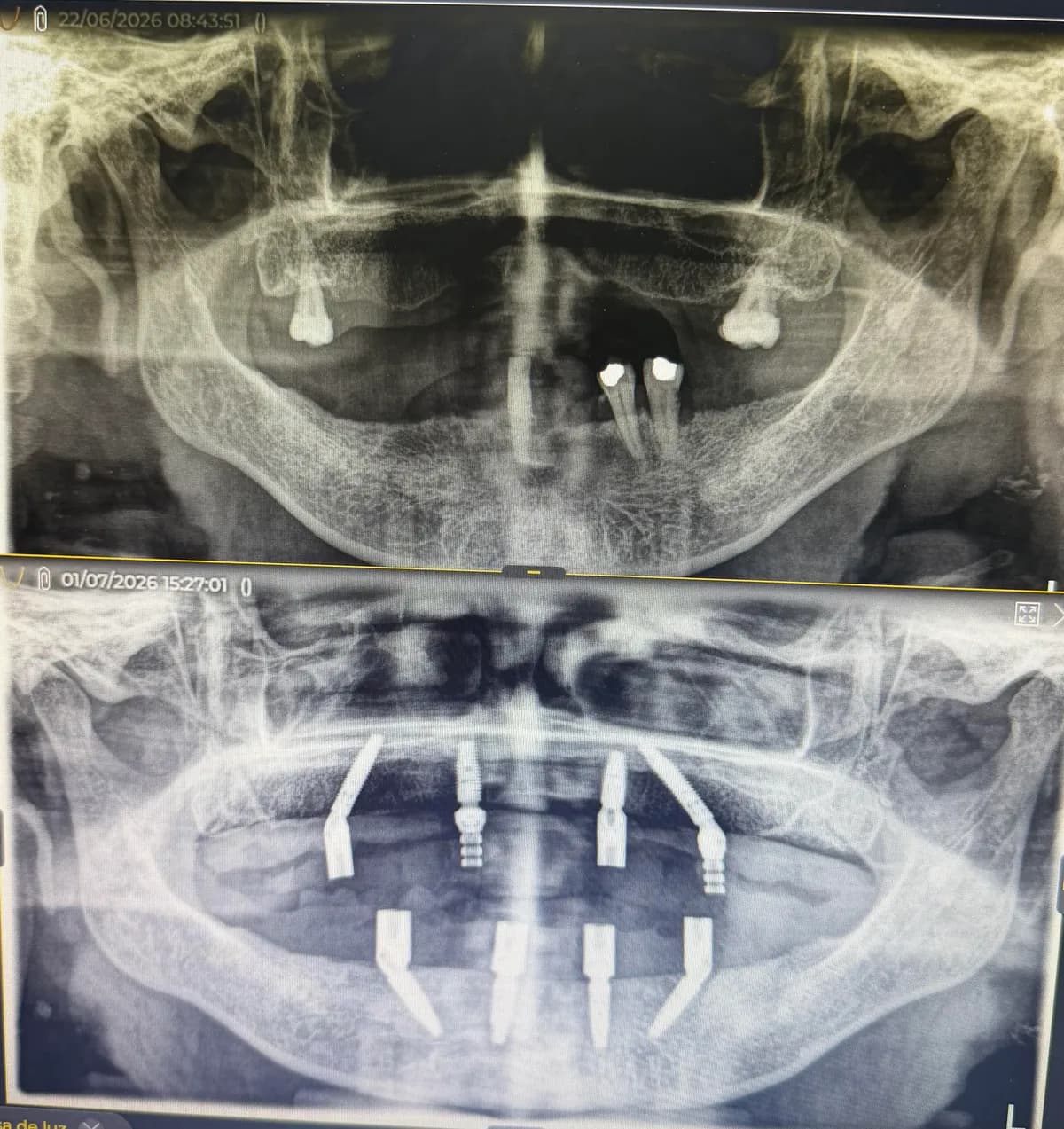 2. Implantes posicionados