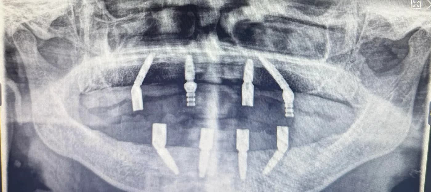 Radiografía panorámica de un caso All-on-4 en Medellín, cuatro implantes con prótesis fija