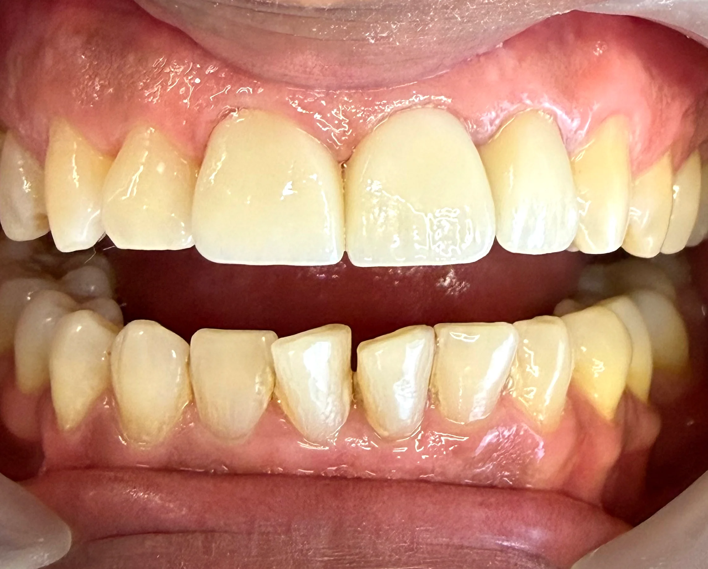 Coronas de zirconio en los dientes centrales, resultado natural y discreto, Medellín