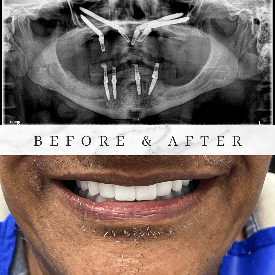 Ilustración de implantes cigomáticos anclados en el hueso del pómulo