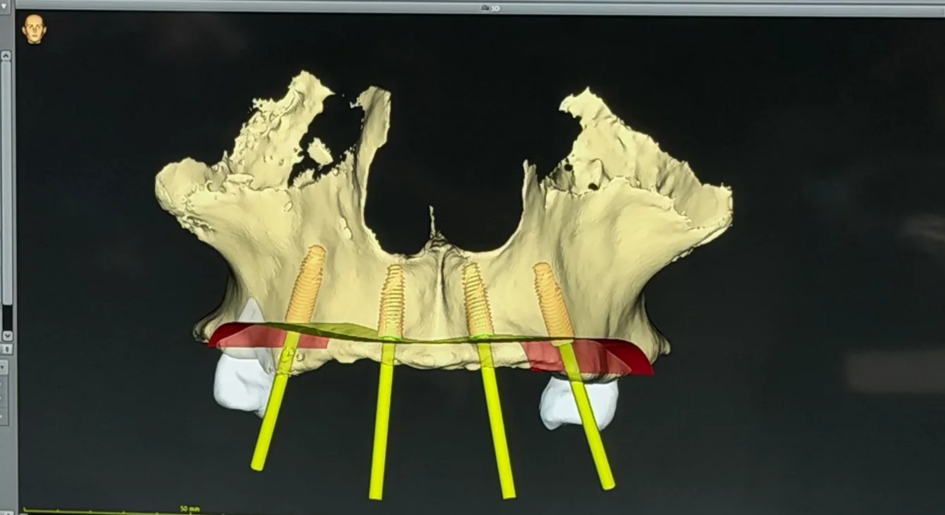Planeación digital 3D de implantes dentales en el maxilar, previa a la cirugía